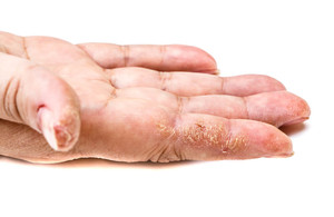 Léčba vitiliga a lupénky